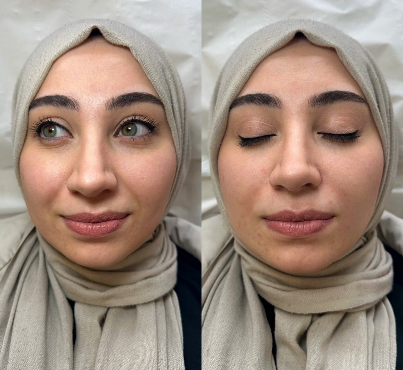 Nasolabial Folds / Marionette Line Filler