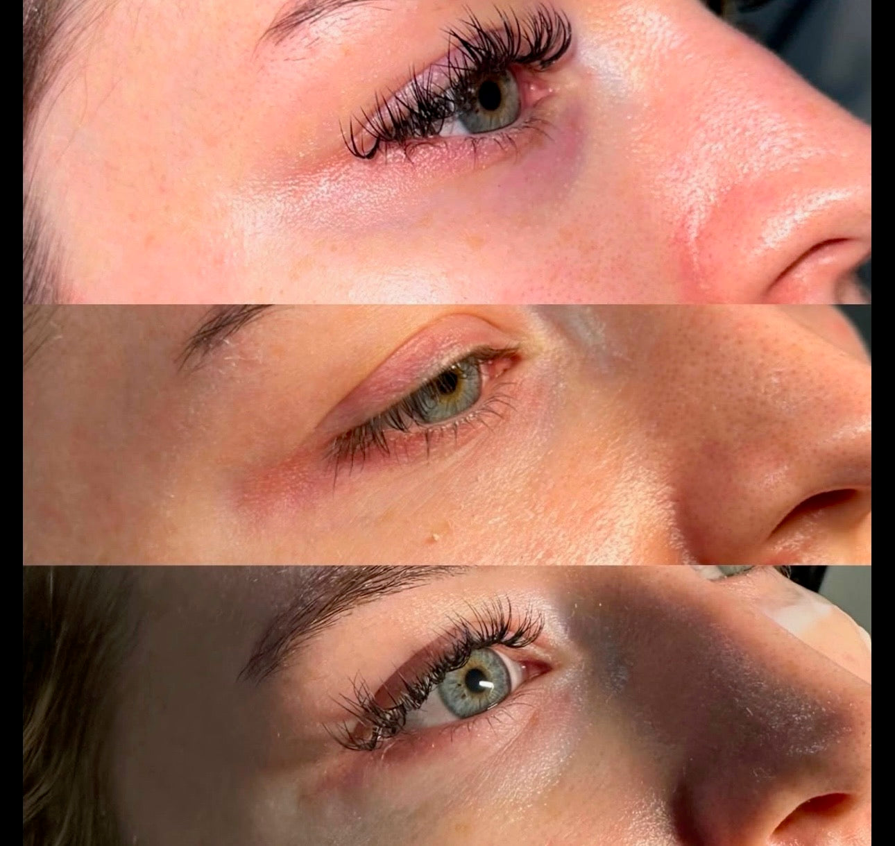 Polynucleotides For Under Eye Rejuvenation