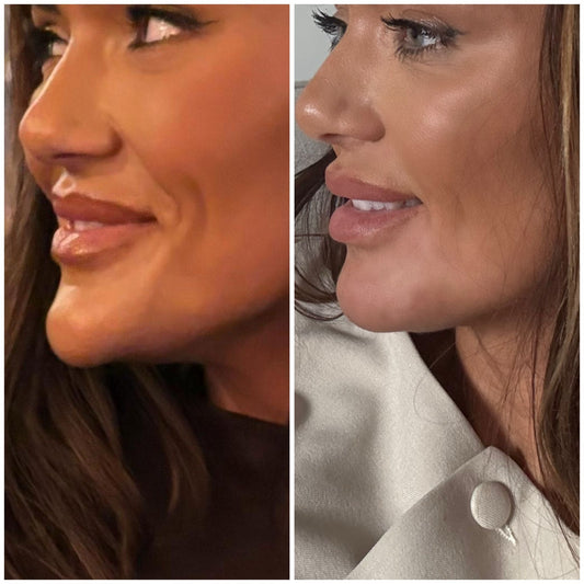 Filler Dissolve 1 Area