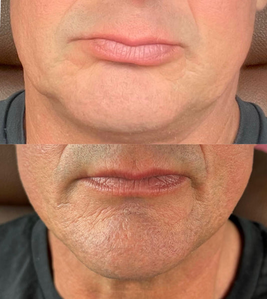 Fat Dissolve Deso Face/Body x 3 - From £280 (Area dependent)