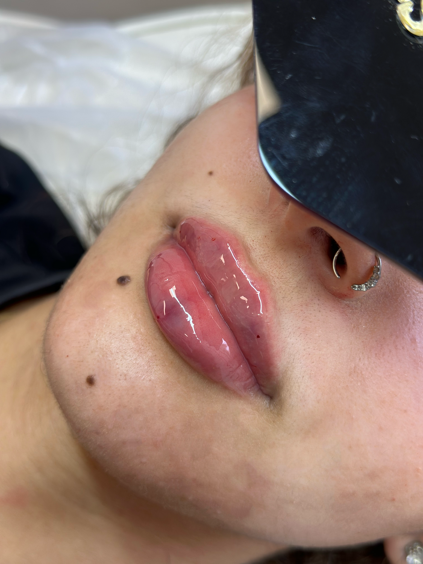 1.1ml Lip Filler