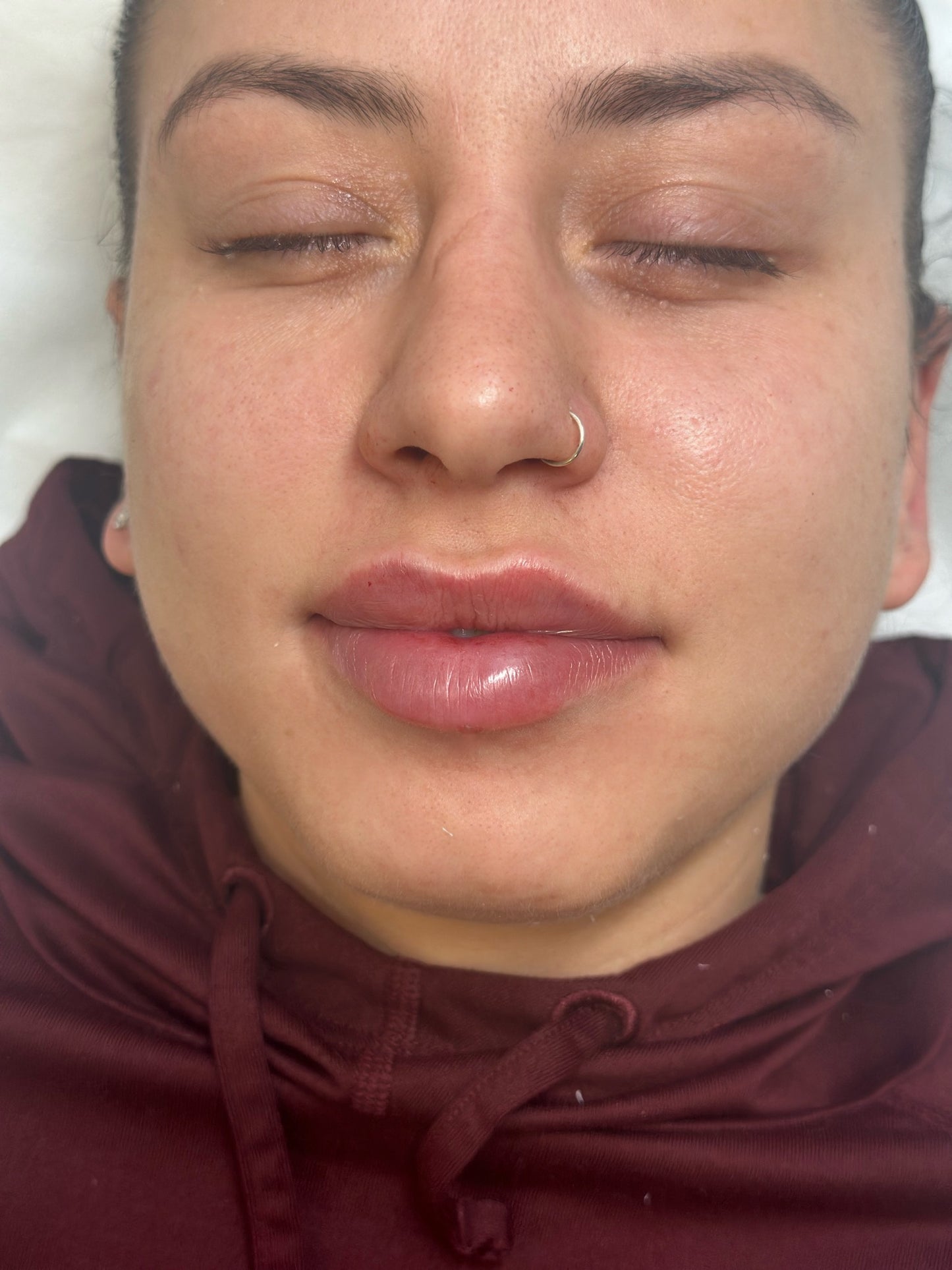 Lip Dissolve & Refill