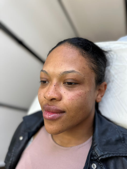 Cheek Filler 0.5ml or 1ml each side